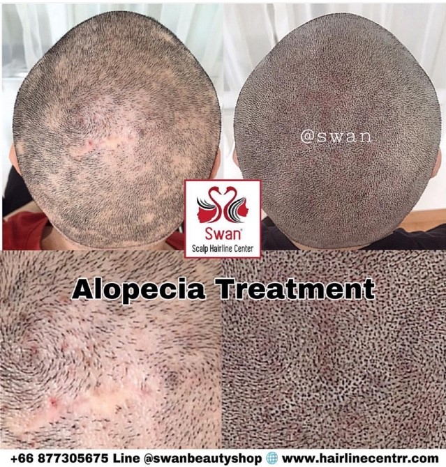 2. Alopecia Areata