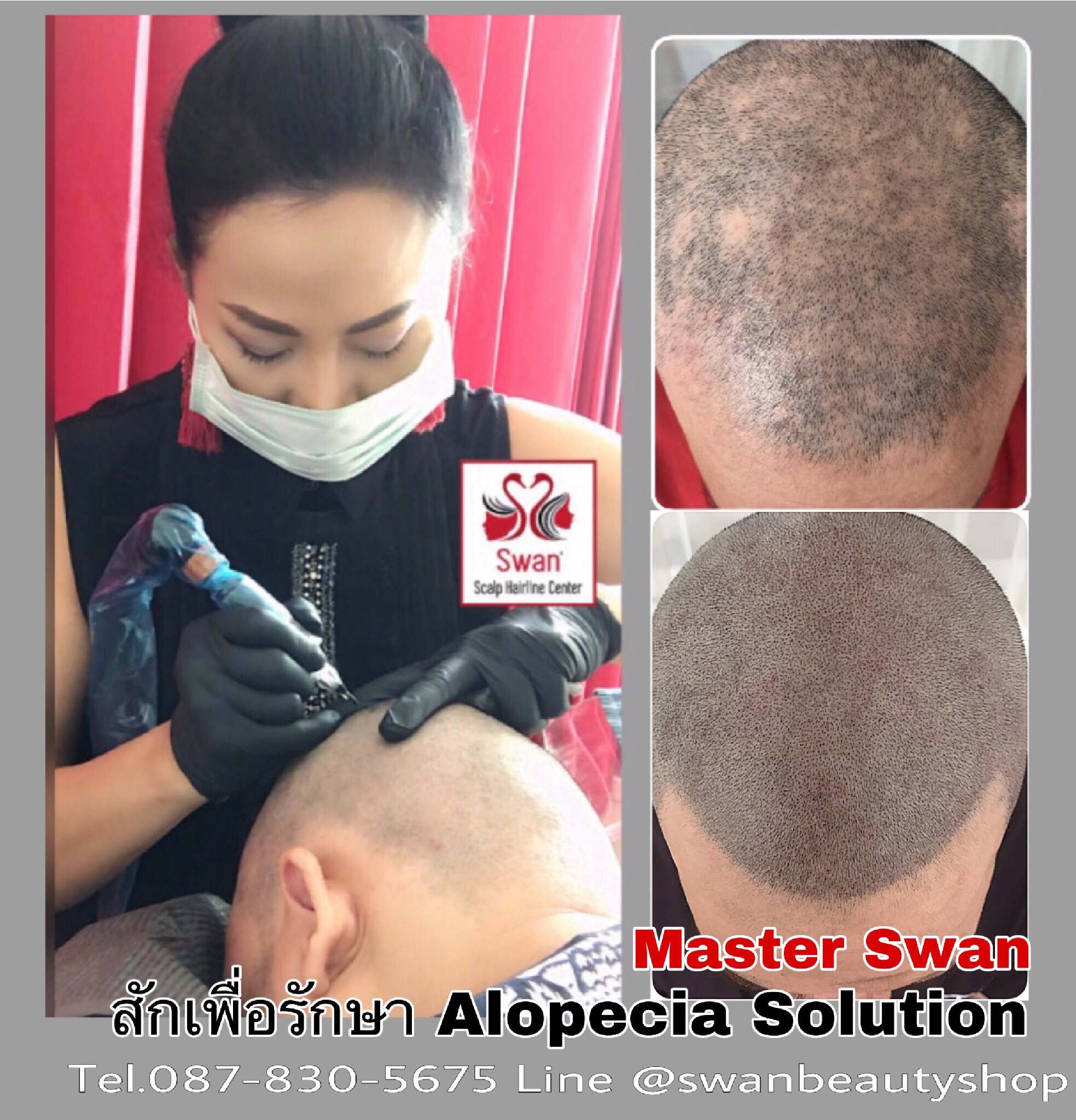 8. Alopecia Areata