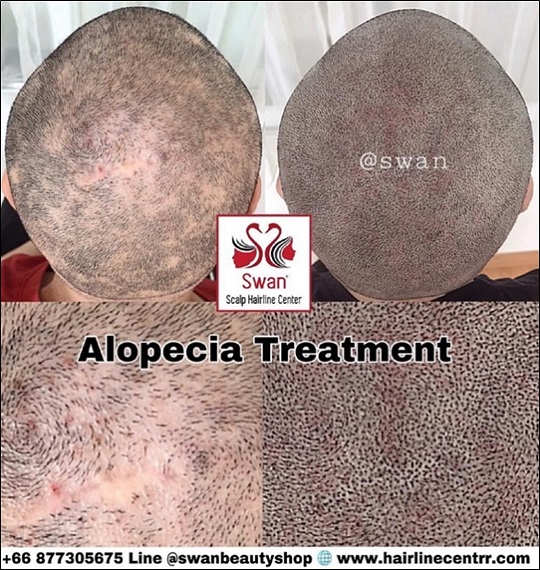 07. โรคผมร่วง Alopecia