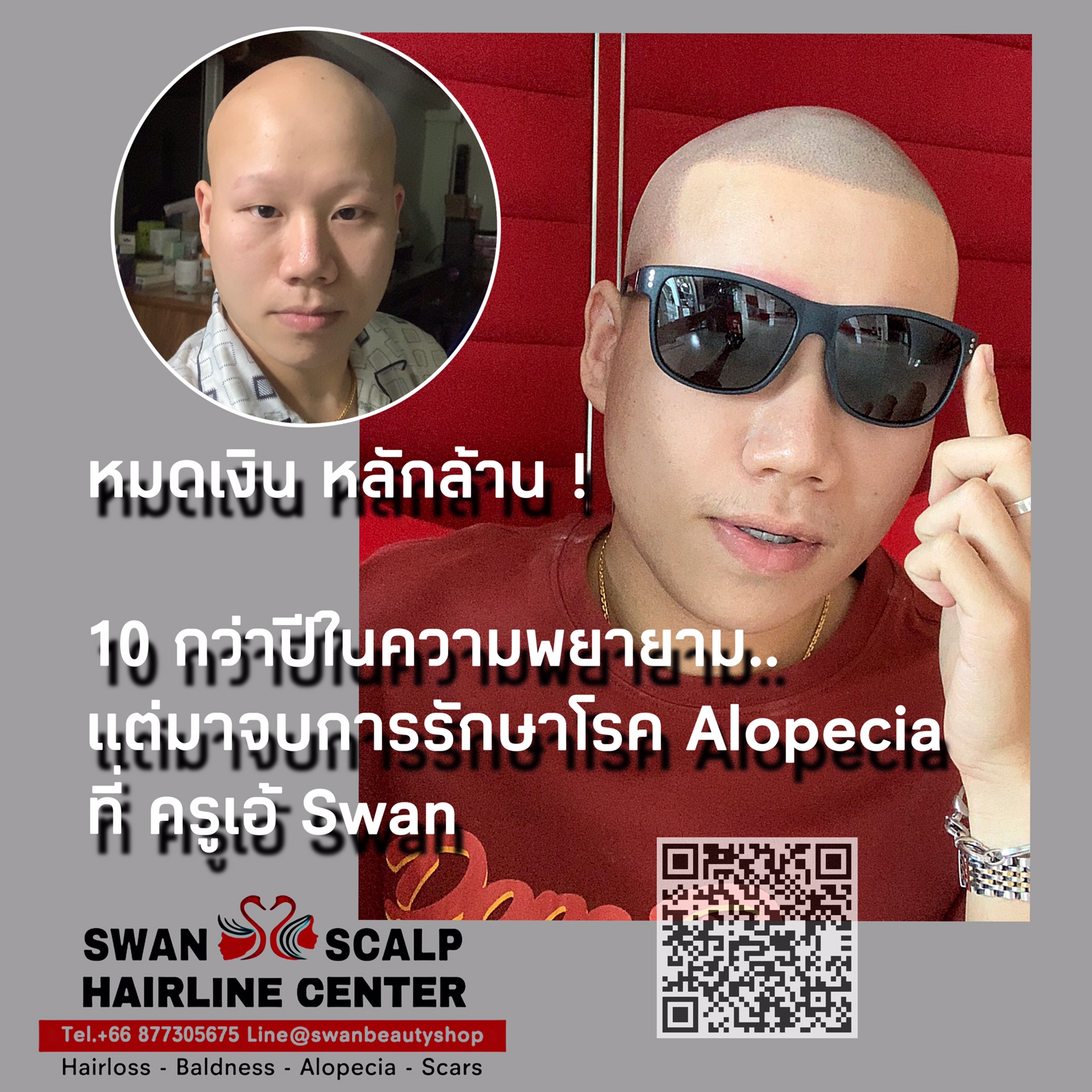 สักสกินเฮดรักษาโรค Alopecia