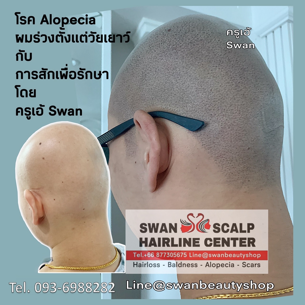 สักเพื่อรักษาโรค Alopecia